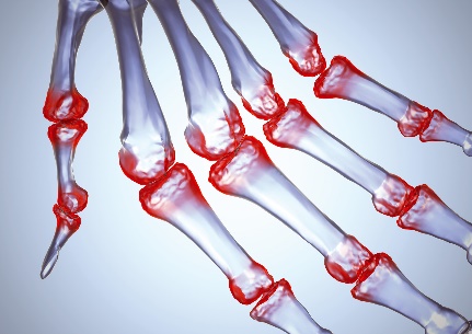 artritas iš rankų sąnarių liaudies gynimo priemonės nuo kaklo osteochondrozės