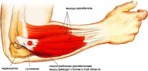 artritas ir alkūnės sąnario dešinės rankos