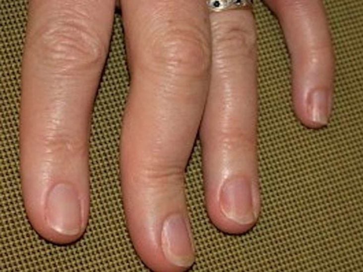 artritas phalanx finger artrozė iš tepalas gydyti