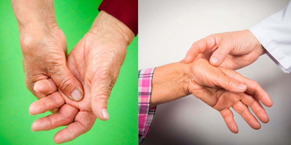 artrozė artritas rankos gydymas liaudies gynimo priemonės