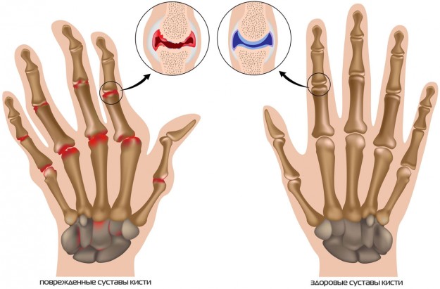 artrozė falangi gydymas kai griebė ranka skauda alkūnės sąnarį