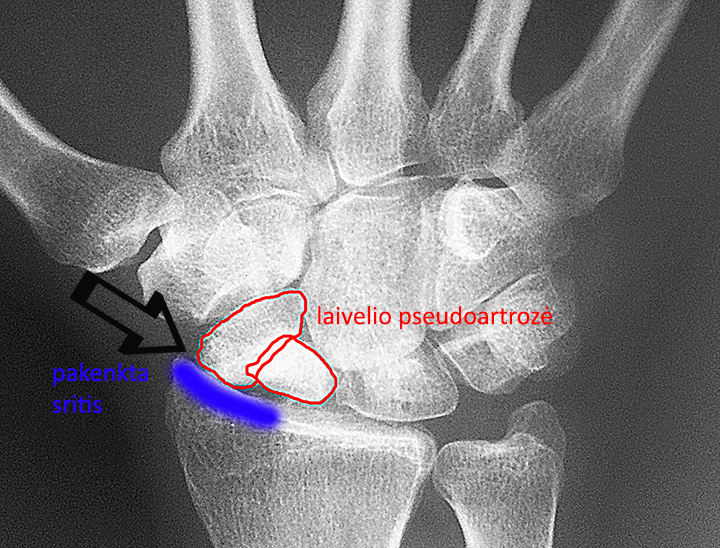 artrozė iš pėdos su plokščiapėdiškumas sąnarių gerklės jungtys mentės ir kaklo