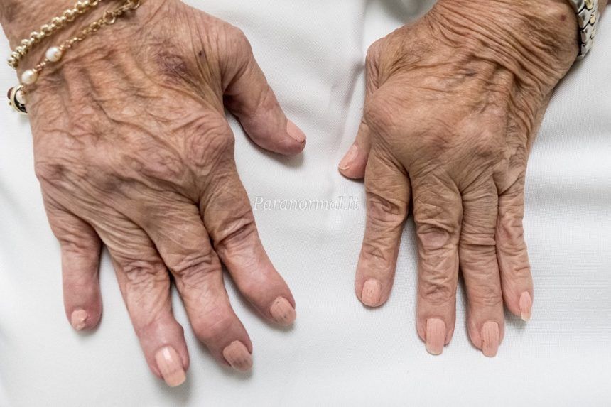 kaip veikia artritas prasideda ant rankų