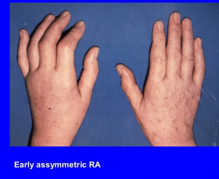artritas ir alkūnės sąnario dešinės rankos