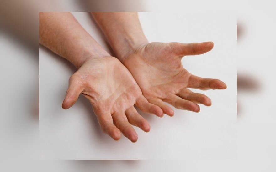artritu sąnarių iš tepalo rankų pirštais skausmas skirtingų sąnarių