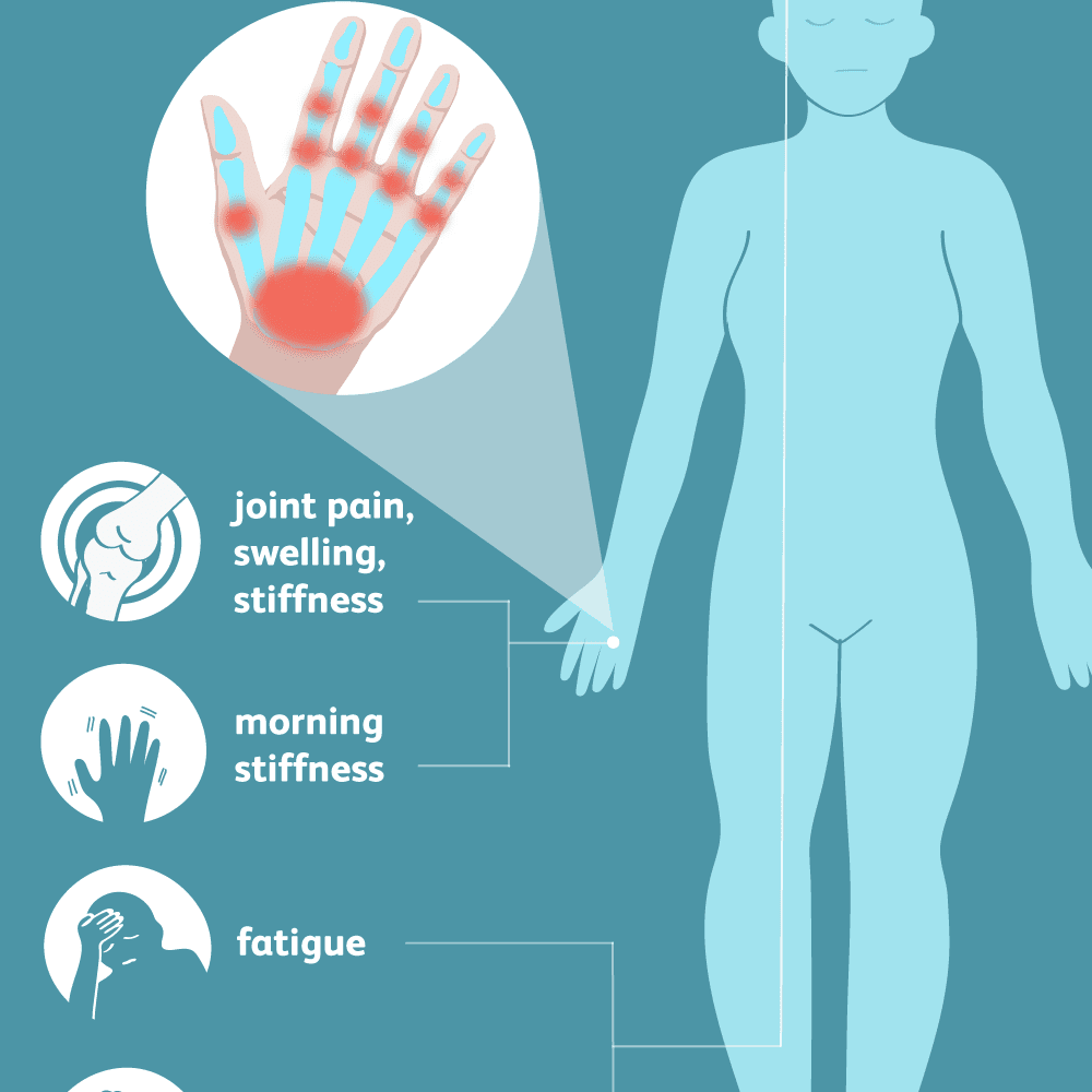 artrozė ir liaudies gydymo metodus kaip išgydyti reumatoidinį artritą