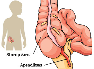 minkštųjų audinių ligos sąnarį kaip artrozė iš rankų sąnarių pasireiškia