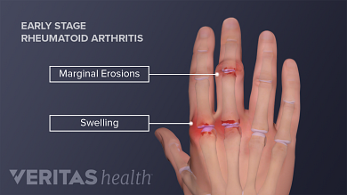 swelling in pain joints jei jie skauda alkūnes į rankas sąnarių