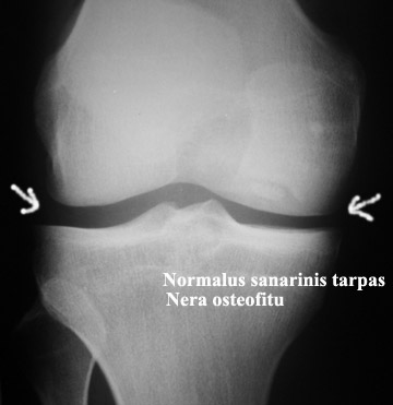 kas yra gydomi artrozė kojų skausmas ne plokščiapėdiškumas sąnarių
