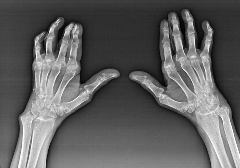 artrozė peties sustav tabletės valymo jausmas dilgčiojimas skausmo rankų sąnarių