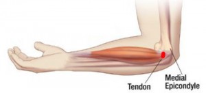 epicondyle alkūnės skausmo skauda kaires rankos raumenis