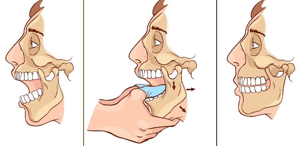 skausmas žandikaulio sąnario atidarant burną iš skausmas alkūnės sąnarių