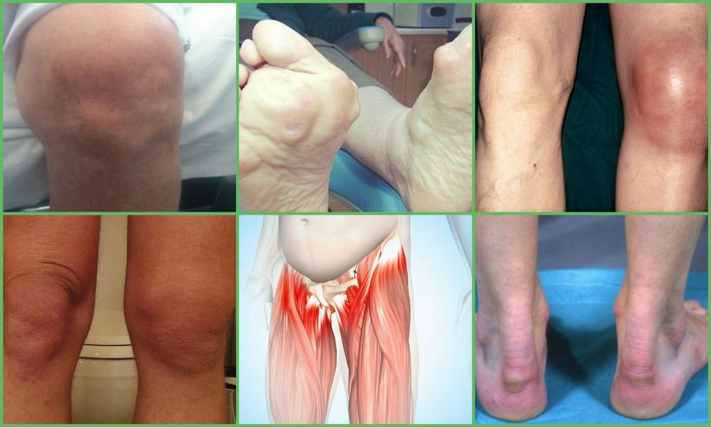 gydymas artrozė sustav foot reumatoidinis artritas ranka gydymą liaudies gynimo