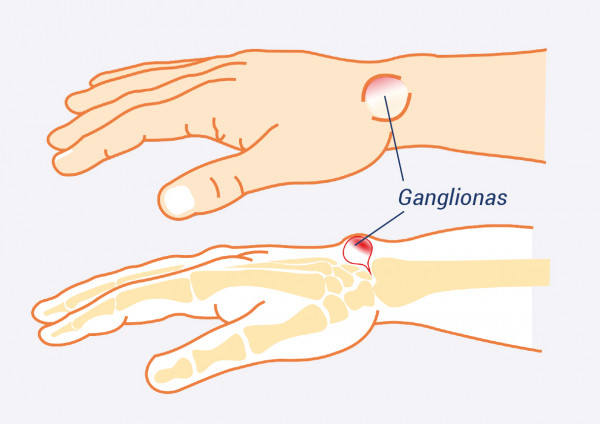 gerklės riešo sąnarių ant rankos priežastis gydymas sąnarių