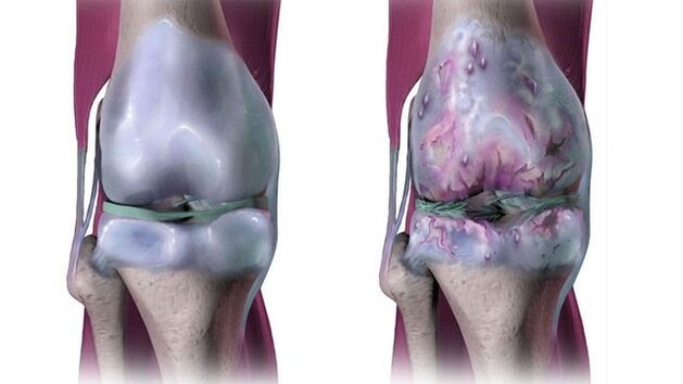 reumatoidinis artritas amzius uždegimas pėdos sąnarių