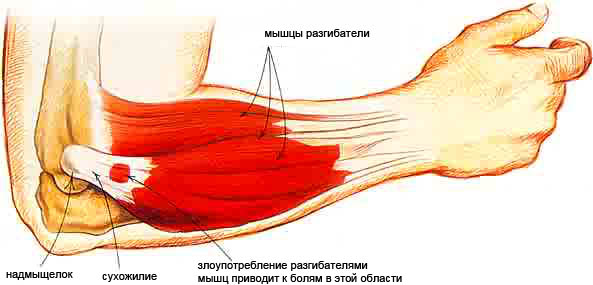 artrozė visų iš karto sąnarių rankos sužeistas alkūnės sąnario