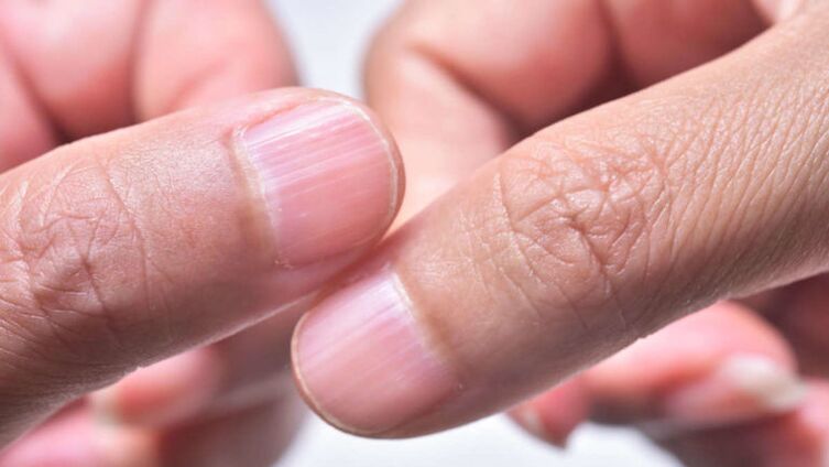 artrozė iš rankų gydymui nykščio iš sąnarių ir jų priežastis ligų vardas