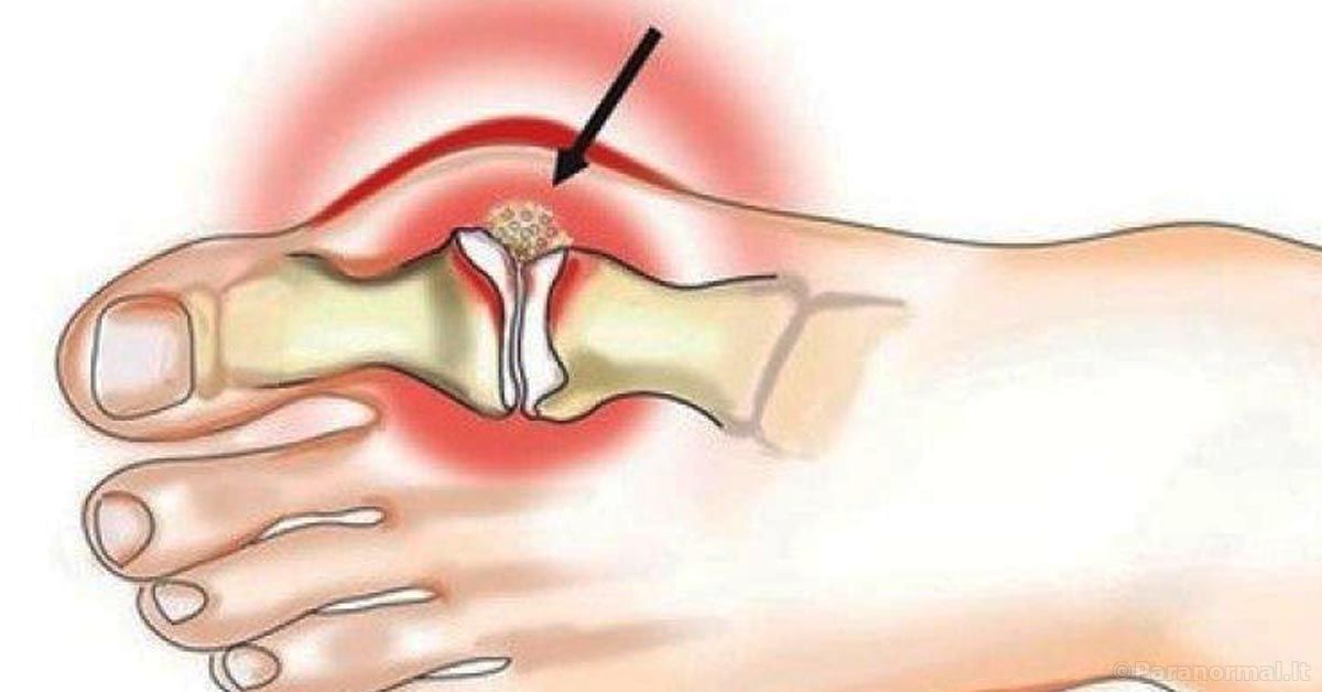 kojos sanariu uzdegimas artrozė artritas sąnarių ligos