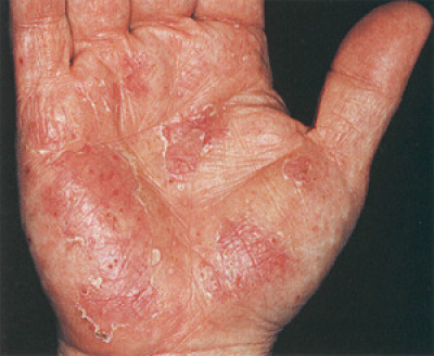 odos ligos ant rankų skausmas bendra pečių dešinėje gydymo
