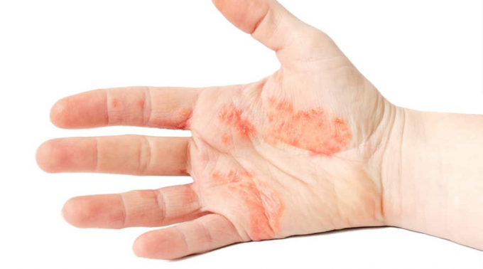 odos ligos ant rankų gydymas alloplant sąnarių