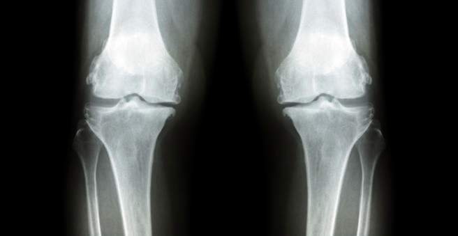 gydymo artritas artrozė apžvalgų skydliaukės skausmas