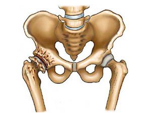 osteoartrozė nuo alkūnės jungties 2 laipsnių gydymo gydymas su ligų sąnarių akonit