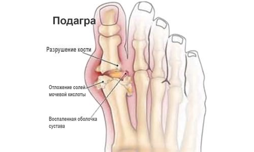 pašalinti patinimas sustav gydymas artrozė sustav foot