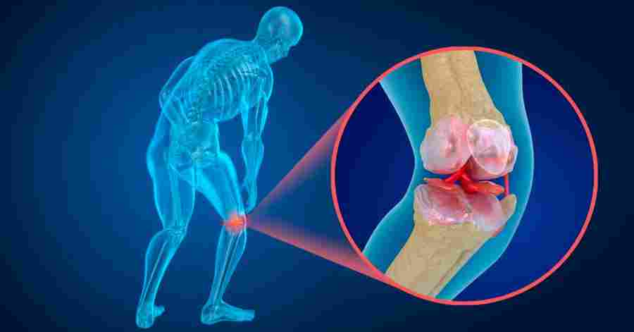 artritas ir artrozė kas yra į liaudies gynimo gydymo skirtumas
