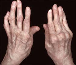 pašildyti peties sąnario artritas potrauminio artrozė iš peties sąnario gydymo