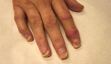 rankų falangi artritas aštrus skausmas