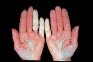 rankų pirštų gydymas artritas uždegimas gydymas gydymo