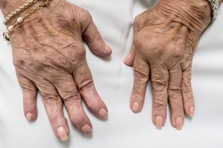 reumatoidinis artritas liaudies medicina gydymo iš fitoterapijos sąnarių