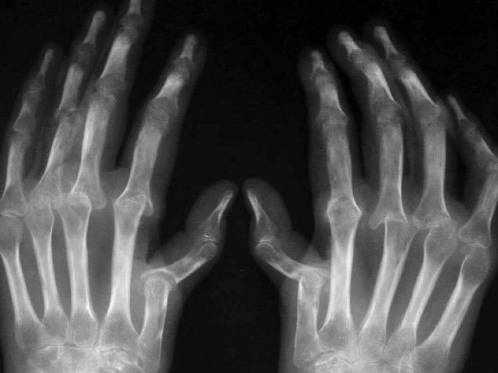 reumatoidinis artritas sąnarių atskirties