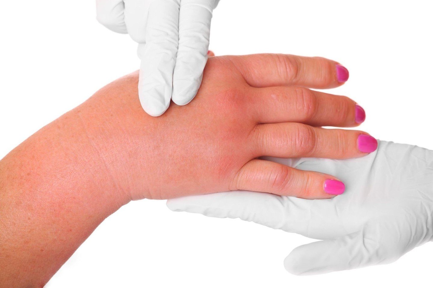 skauda sąnarį ant rankos piršto kai lankstant gydymas
