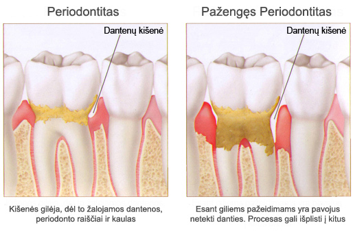 skauda sąnarį dantenų gliukozaminas gerklės sąnarių