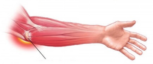 skausmas alkūnės sąnario kai lankstant nuo bicepsas