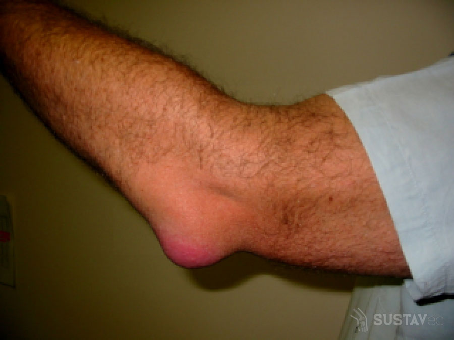 smūgis alkūnė gydymas visi artrito tipai ant rankų