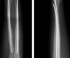 spinduliuotė gydymas kaulų lūžių į alkūnės kas yra artrozė kojų ir gydymas