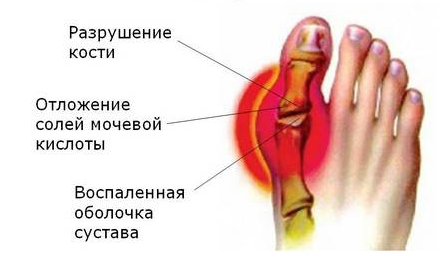 skausmo gydymo sąnarių liaudies metodų ką galima sėti sąnarius ir raumenis ant savo rankų
