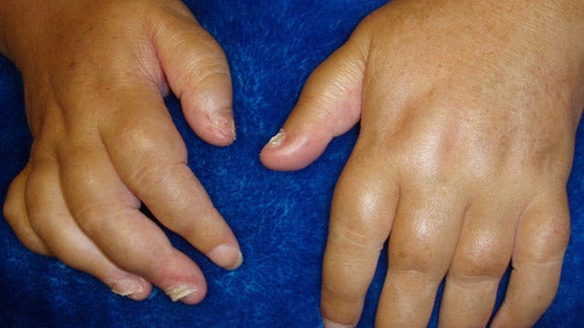 swelling your joints iš sąnarių ligomis papildymas