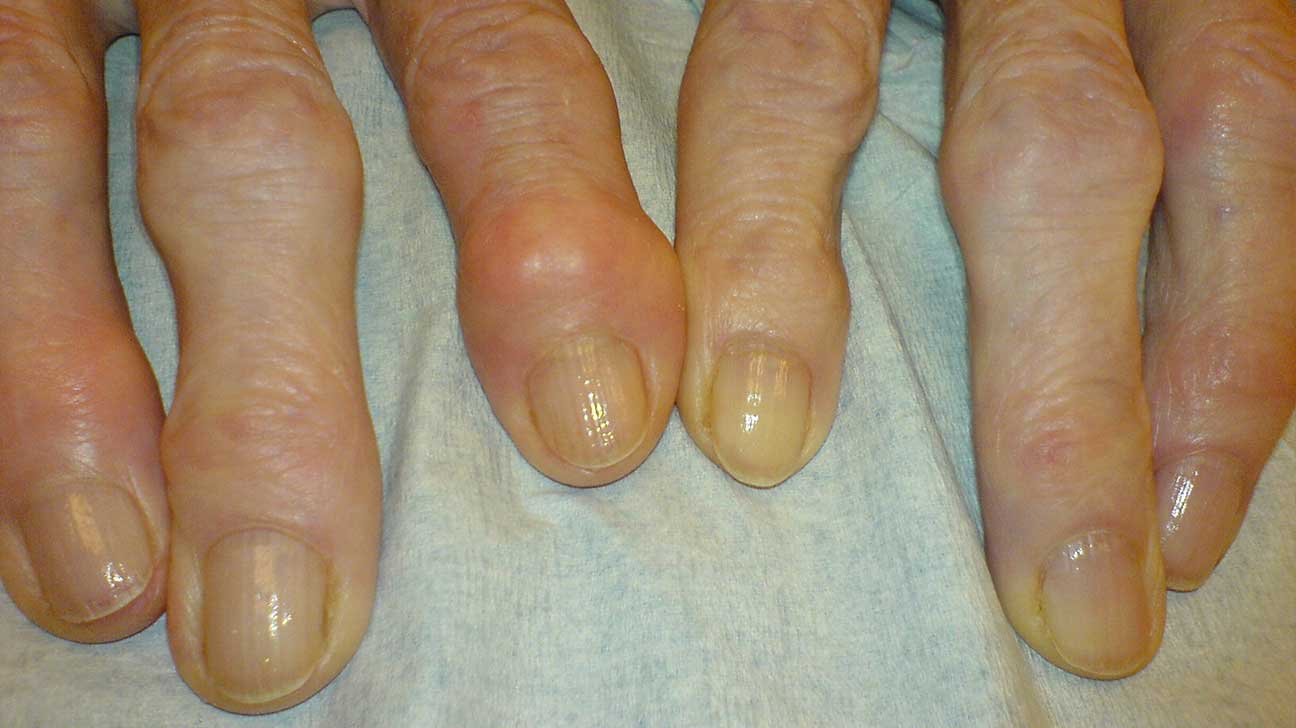 swollen painful finger joints morning mazi už sąnarių uždegimu gydymas
