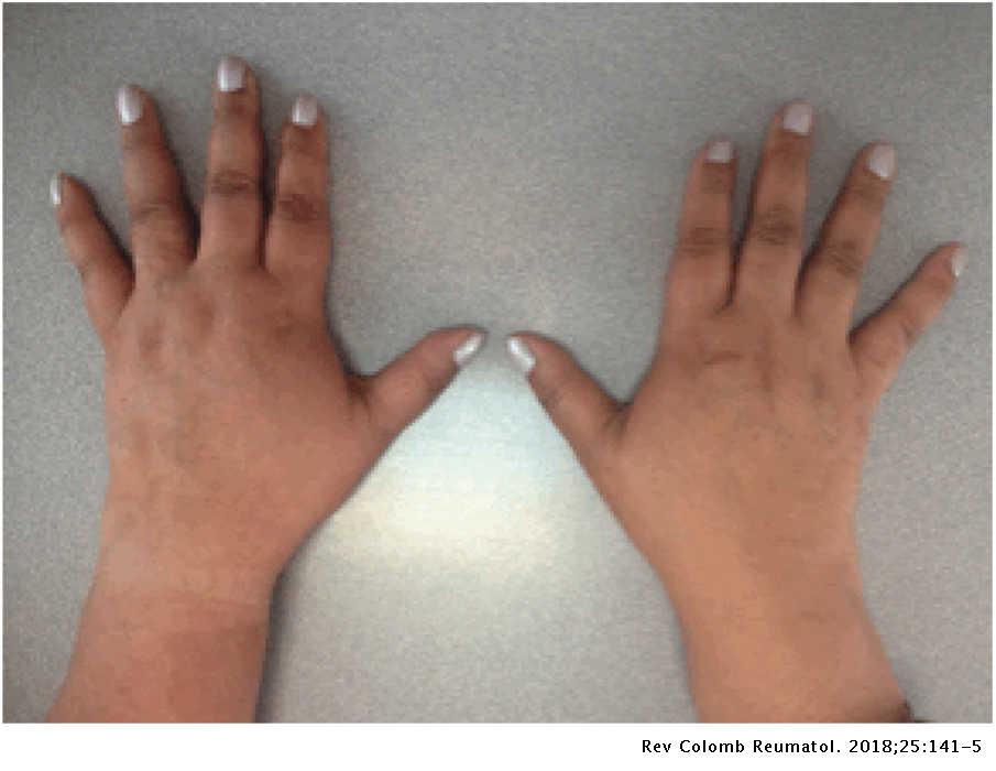 swollen painful finger joints pregnancy tepalas gerklės sąnarių