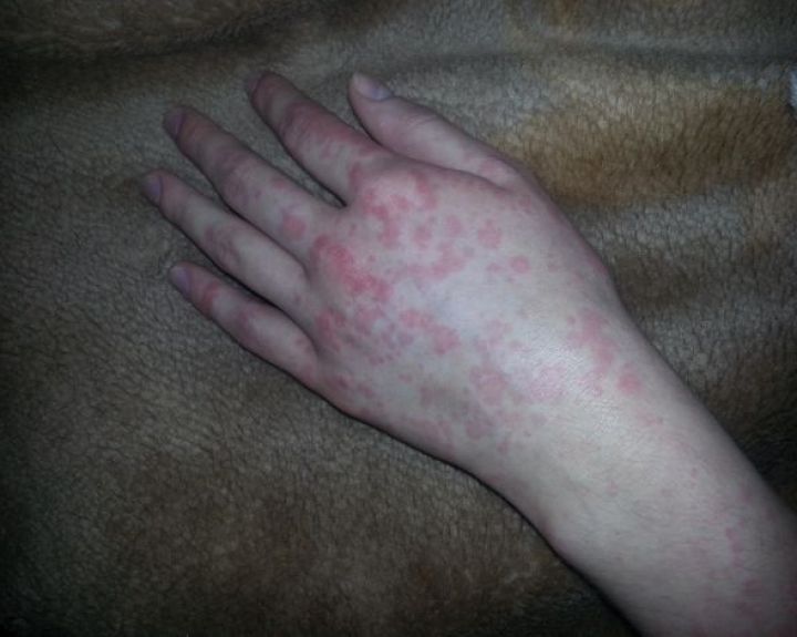 alergijos sąnarių liga