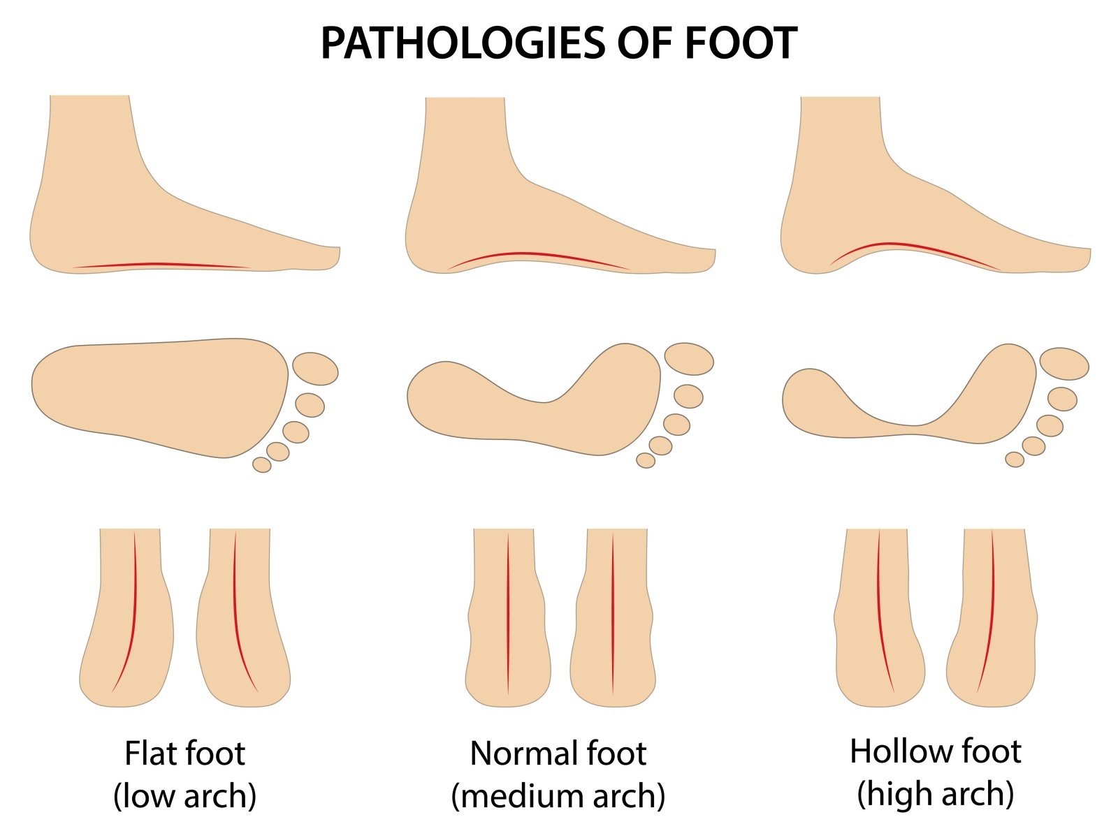 šis mažas pėdos pėdos artritas šepetys skauda bendras priežastis