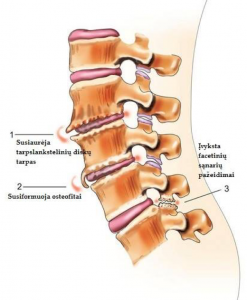 nugaros osteochondrozė kas tepalas padeda nuo osteochondrozės