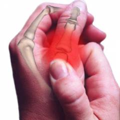 artritas arba sąnarių uždegimas tepalas į artrito nuo rankų sąnarių