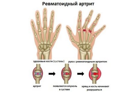 iškilimų ant rankos liaudies gynimo sąnarių kamieninės ląstelės gydymas sąnarių