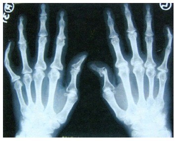 artrozė arba artrito gydymo rankų stuburo kremzles trukimas