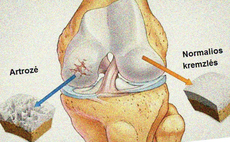 skauda kairi sona nugaros apacioje sąnarių skausmas urologija