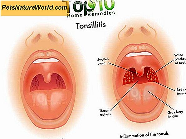 lėtinis skausmas tonsillite apyrankė dėl sąnarių gydymo